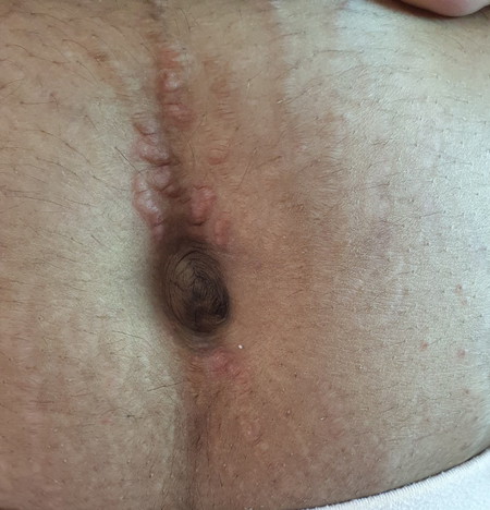 mummy belly