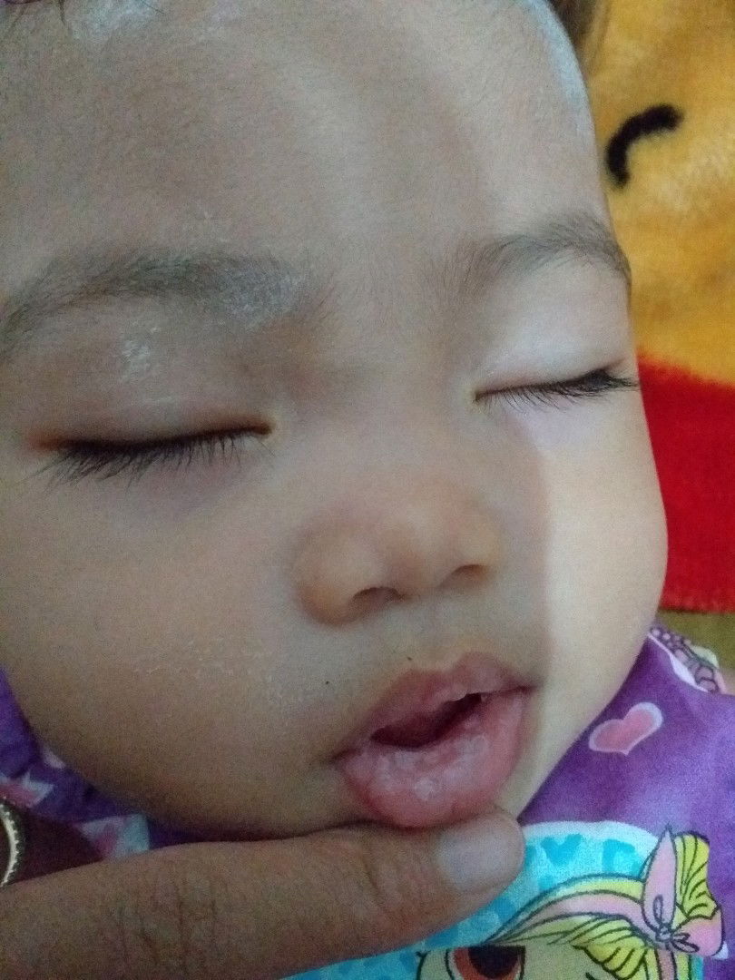 sariawan bayi