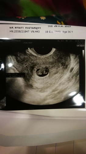 7week ตามหมอ 9 weekตาม แอฟ ไม่พบหัวใจเด็ก