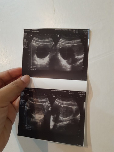 อยากถามหน่อยค่ะ คือเราตรวจการตั้งครรถ์เมื่อวันที่ 20/5/64 ขึ้น 2 ขีด