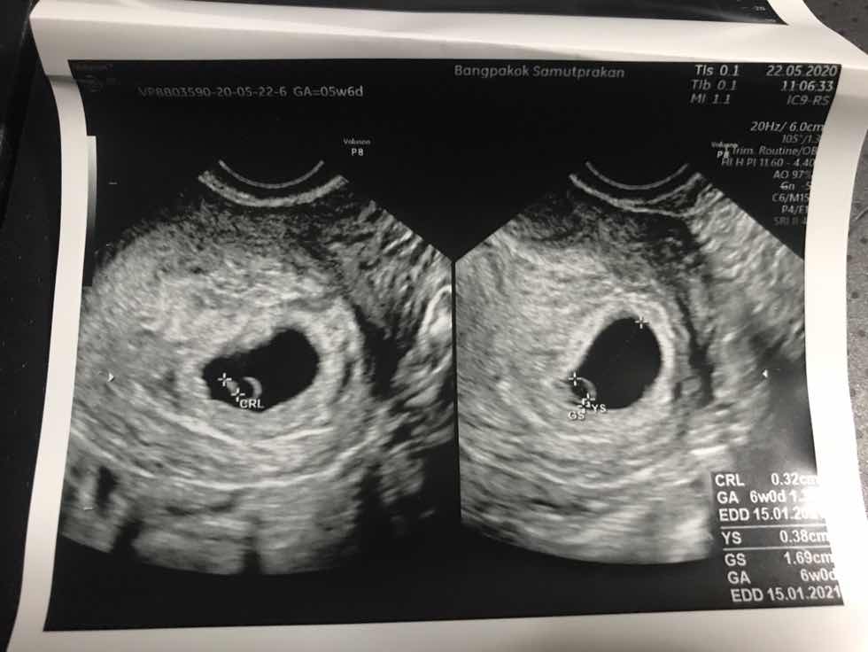 เพิ่งรู้ว่าท้องได้6W ก่อนหน้านั้นกินแอลกอฮอล์ พักผ่อนน้อย จะส่งผลต่อน้องมั้ย?