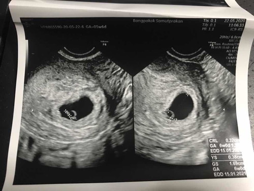 เพิ่งรู้ว่าท้องได้6W ก่อนหน้านั้นกินแอลกอฮอล์ พักผ่อนน้อย จะส่งผลต่อน้องมั้ย?