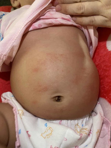 น้องอายุ 2 เดือน 12 วัน มีผื่นขึ้นที่หน้าท้อง