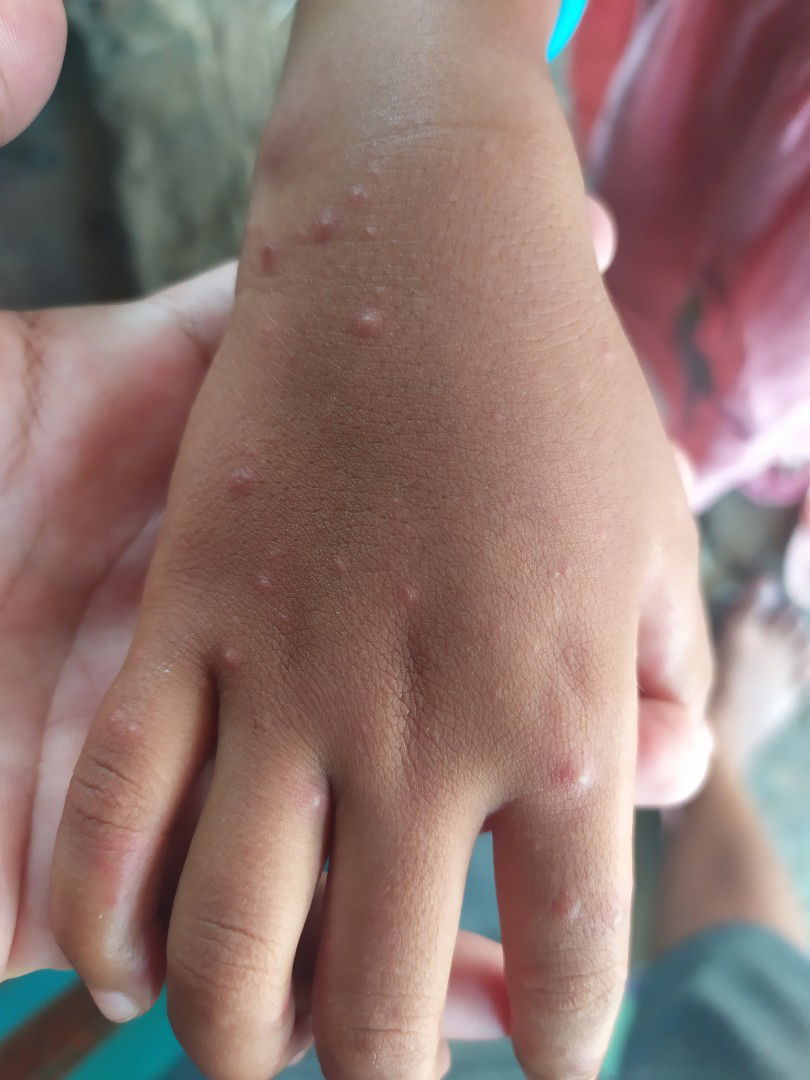 tangan mengeluarkan cacar air