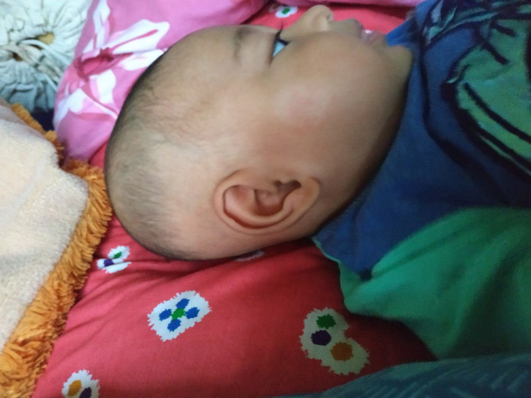 Ruam pipi bayi
