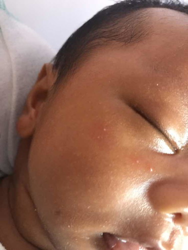 Oily face ni baby