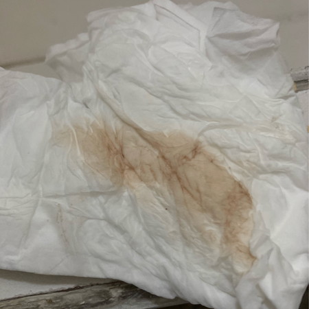 มีเลือดออก