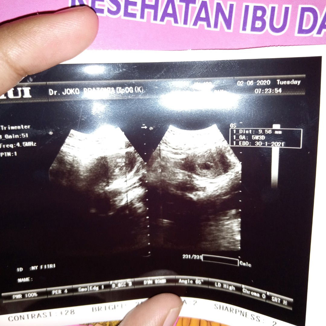 hitungan tidak sesuai USG