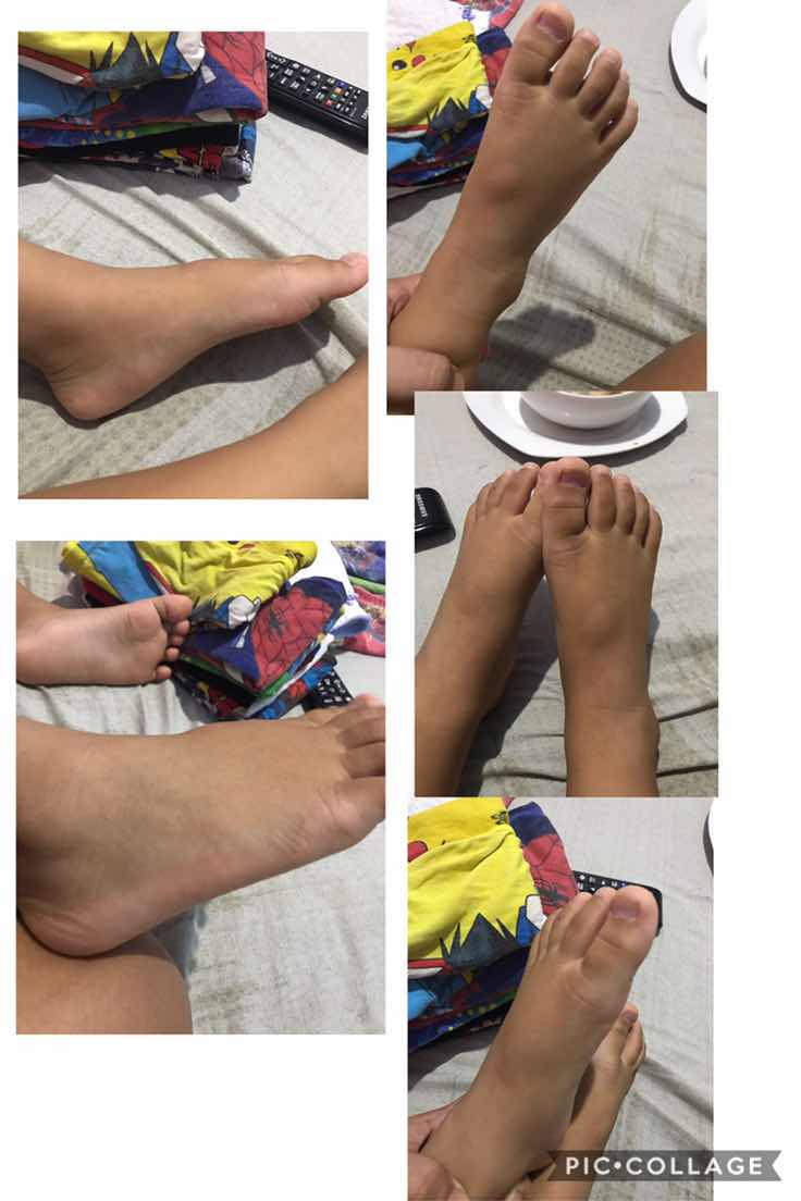 Mga mommies yung paa ng son ko 4yrs old nagkaron ng lump/bump parehas pa ng pwesto, may scheduled check up nako sa pedia next week, looks like a cyst