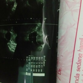 apa maksut dri hasil usg ini