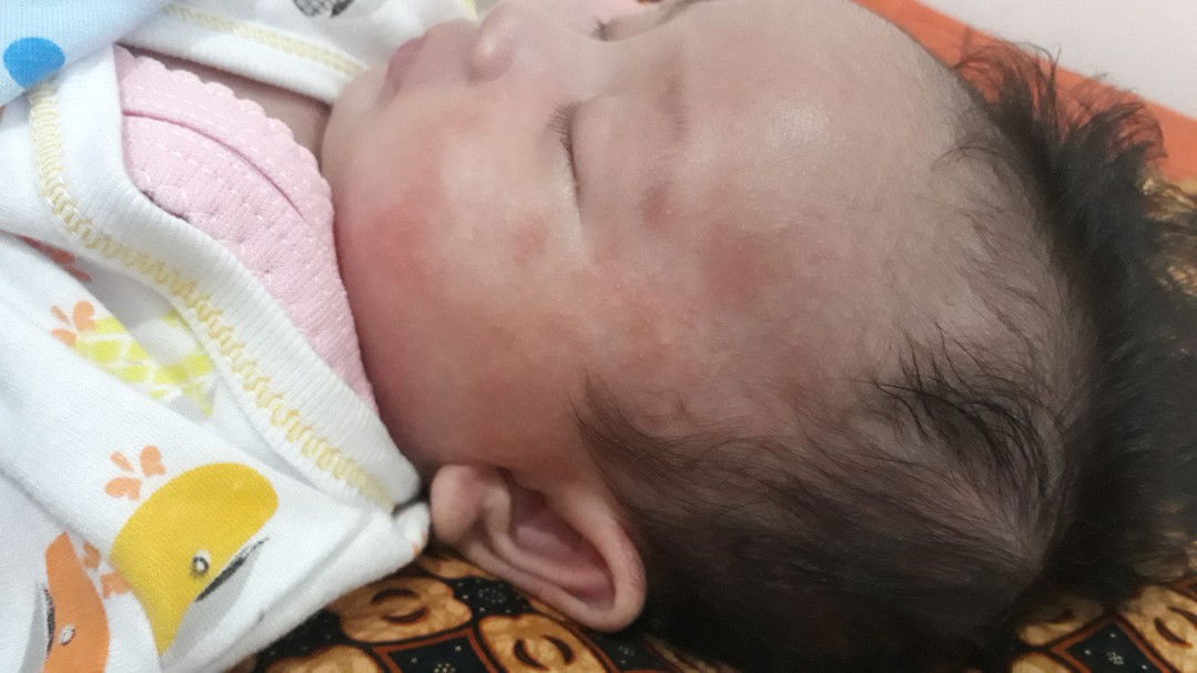 bintik2 merah di wajah anak