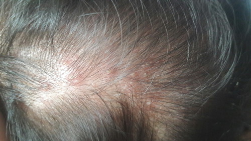 Bukol at butlig sa ulo