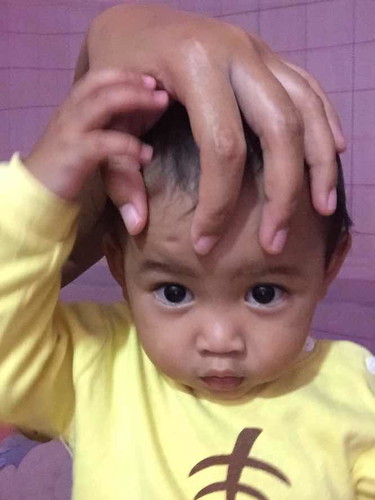 ลูกมีรอยบุ๋มที่หน้าผาก