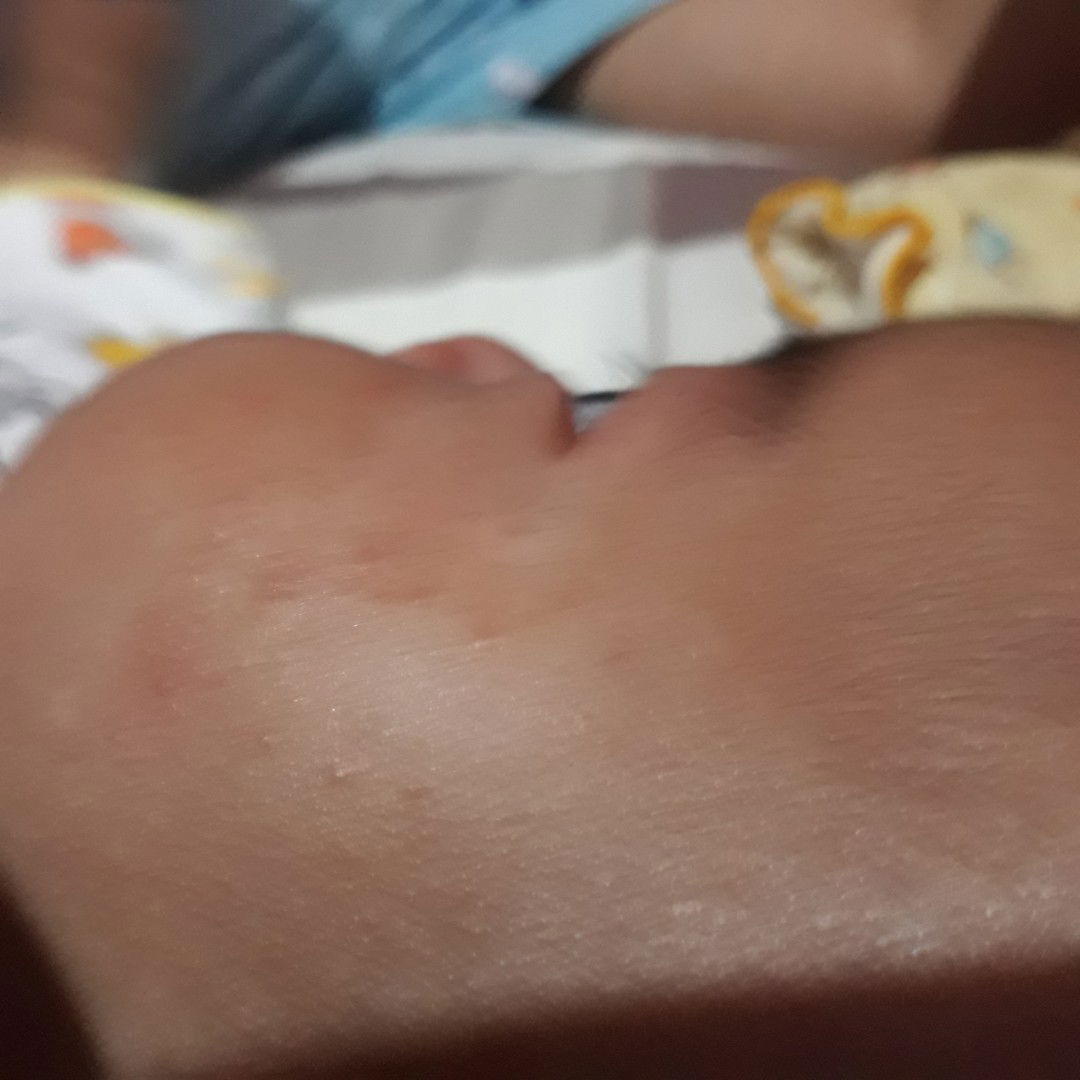 Kulit bayi bintik merah kenapa yah solusinya bagaimana