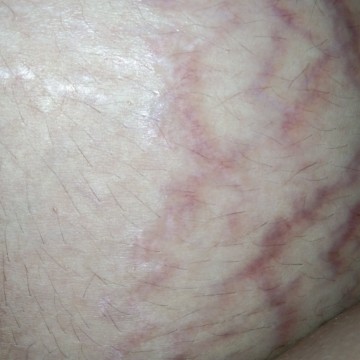 stretch mark 😩