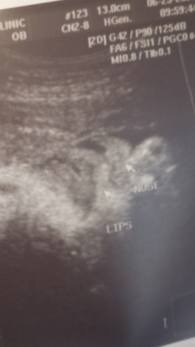 ultrasound