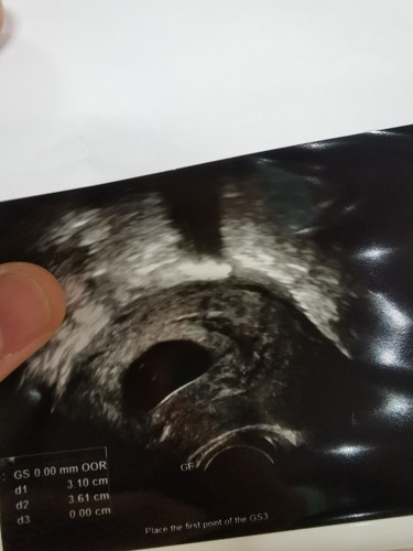 11สัปดาห์ แต่....