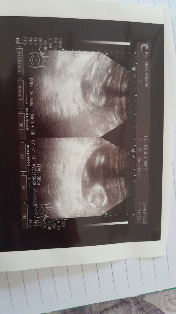 Tanya donk bunda" usg bru 14wek bb udah 689gram ..
Ada yg sama gak