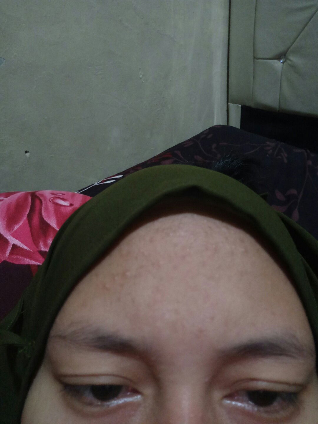 bruntusan dan jerawat