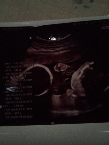 แฝดค่ะท้องได้ประมาณ24w3dน้ำหนักแฝดต้องอยู่ที่เท่าใรคะ