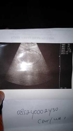 Kehamilan 6 minggu 2 hari