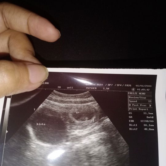apakah aman kista selama kehamilan??