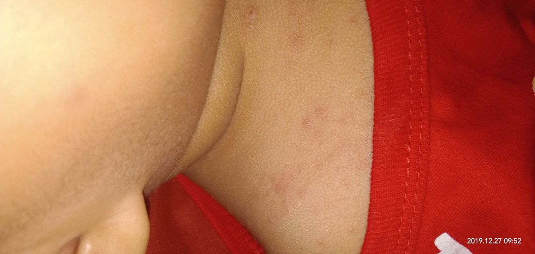 bayi usia 1 th alergi atau beruntusan parah hampir sekujur tubuh sampai ke dubur