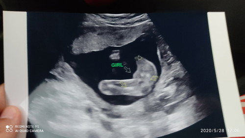 scan gender