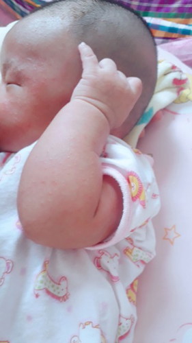 ผดเล็กๆ