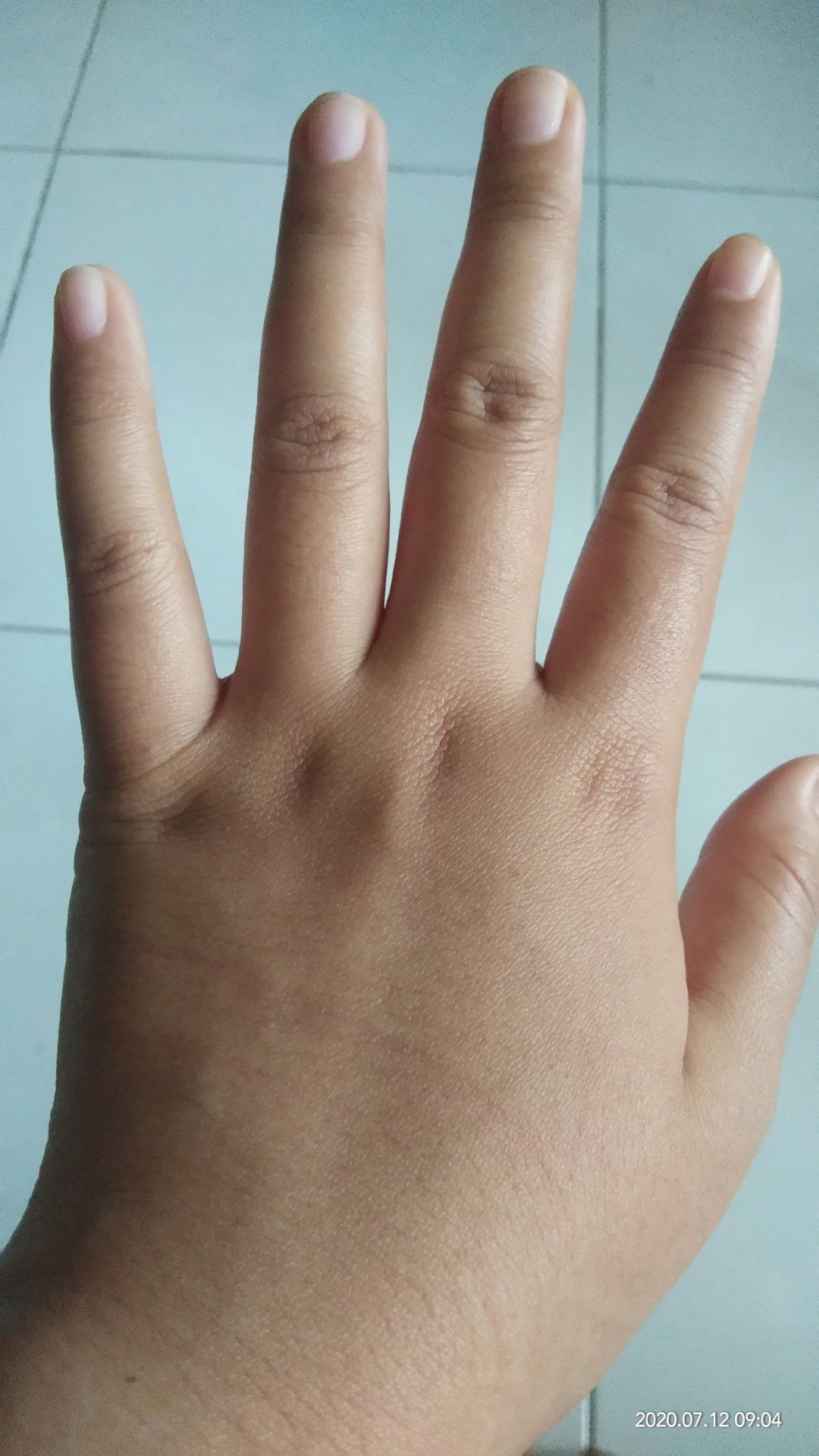 tangan dan kaki bengkak di uk 18w5d