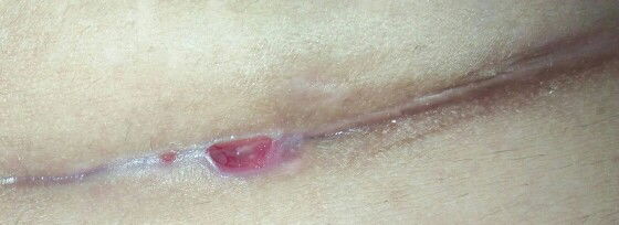 jahitan sesar belum membuka