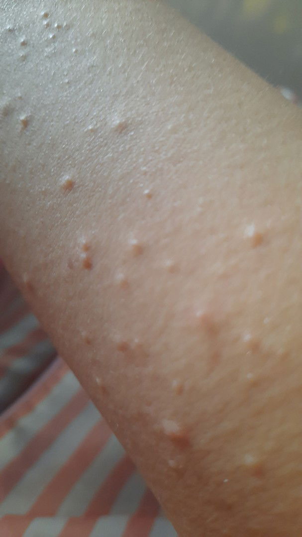 sau khi sanh em bé được 4 tháng thì da nổi mụn nước khắp cơ thể