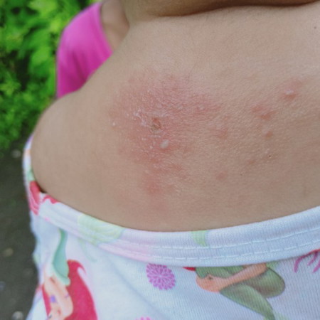insect bites ho ba Ito?