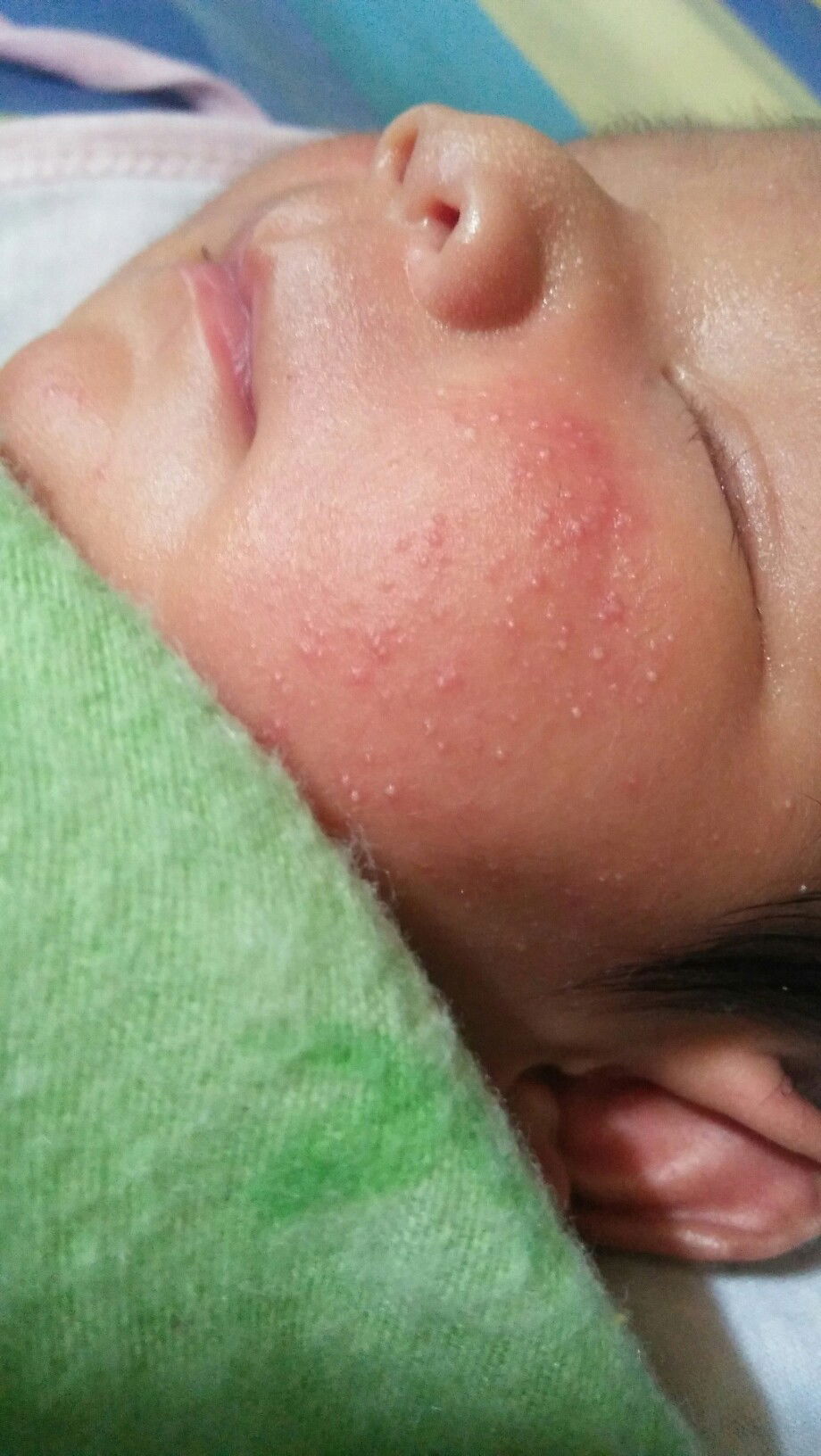 bruntusan di pipi bayi