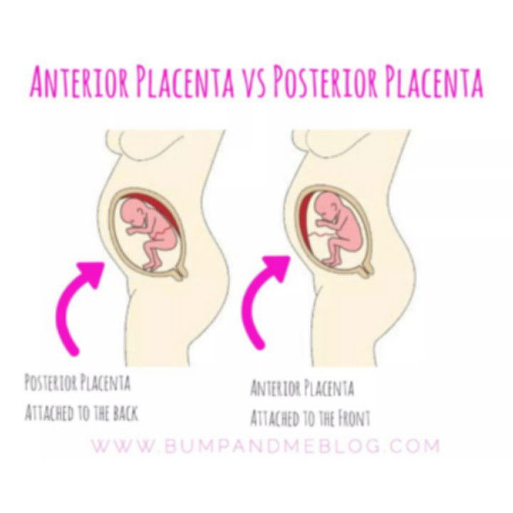 Anterior Placenta