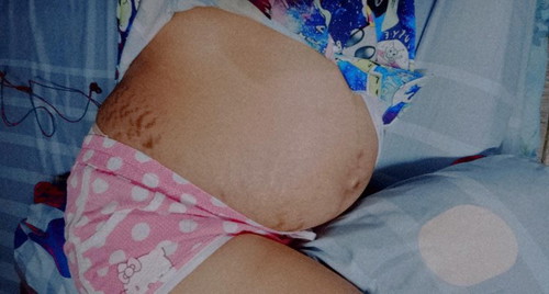 รอยเเตกลาย