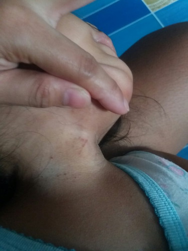 preakly heat/bungang araw