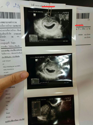 วันนี้ไปอัลตร้าซาวนด์มาแล้วคับ