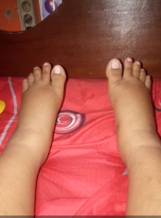 kaki bengkak