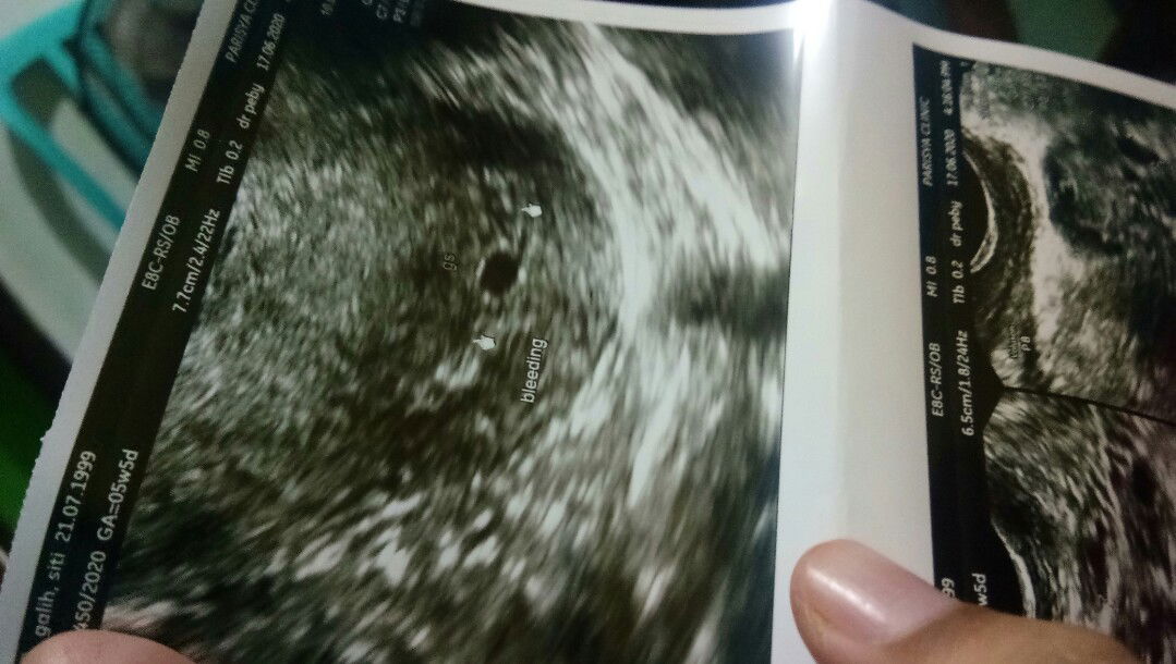 Belum ada yolk salc di kantung kehamilan 5w5d?