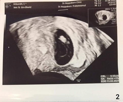 เราสามารถเห็นหัวใจของลูกกี่วีคค่ะ