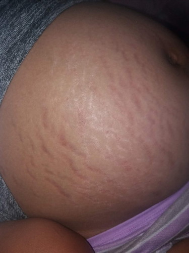 Stretch Marks