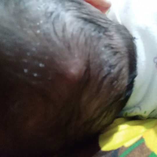 Salep Untuk Bentol / Sengatan Serangga