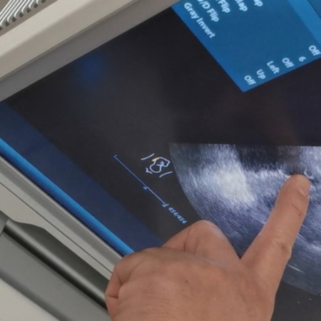 เจอถุงไข่แดง ไม่ได้ท้องลมใช่ไหมค่ะ