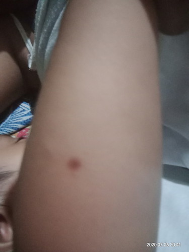 bruises on my baby