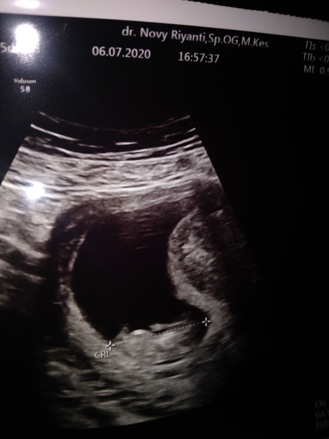 Bahagia setelah USG