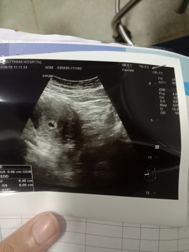 ท้องอ่อนหรือท้องลม