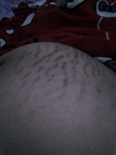 Garis2 Di Perut