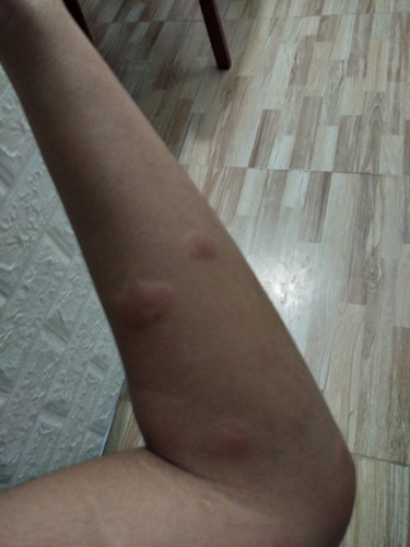 SKIN RASHES ?