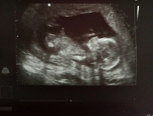 ULTRASOUND